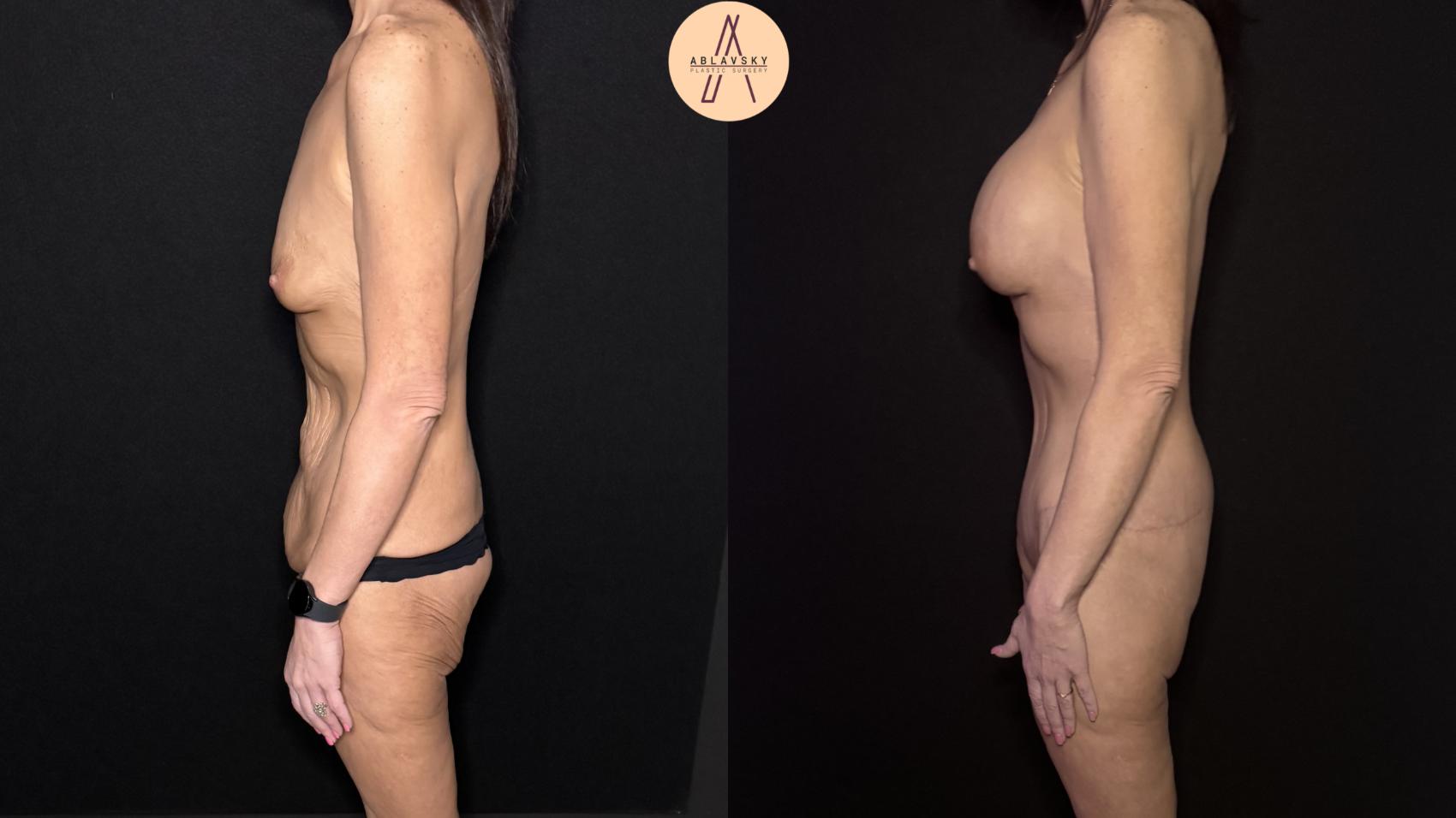Before & After Lower / circumferential body lift Case 483 Left Side View in San Antonio, Texas