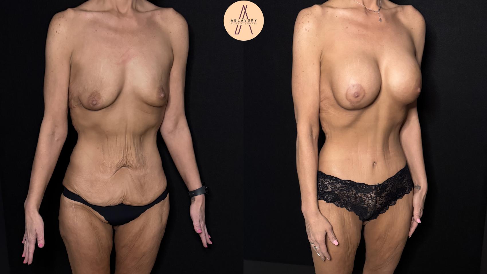 Before & After Lower / circumferential body lift Case 483 Right Oblique View in San Antonio, Texas