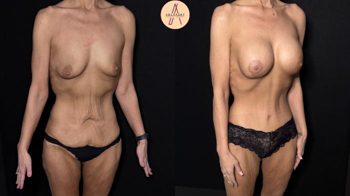 Before & After Lower / circumferential body lift Case 483 Right Oblique View in San Antonio, Texas