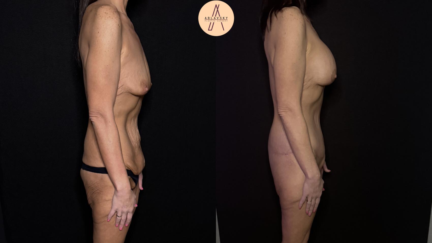 Before & After Lower / circumferential body lift Case 483 Right Side View in San Antonio, Texas