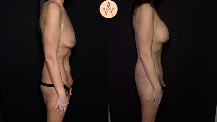 Before & After Lower / circumferential body lift Case 483 Right Side View in San Antonio, Texas