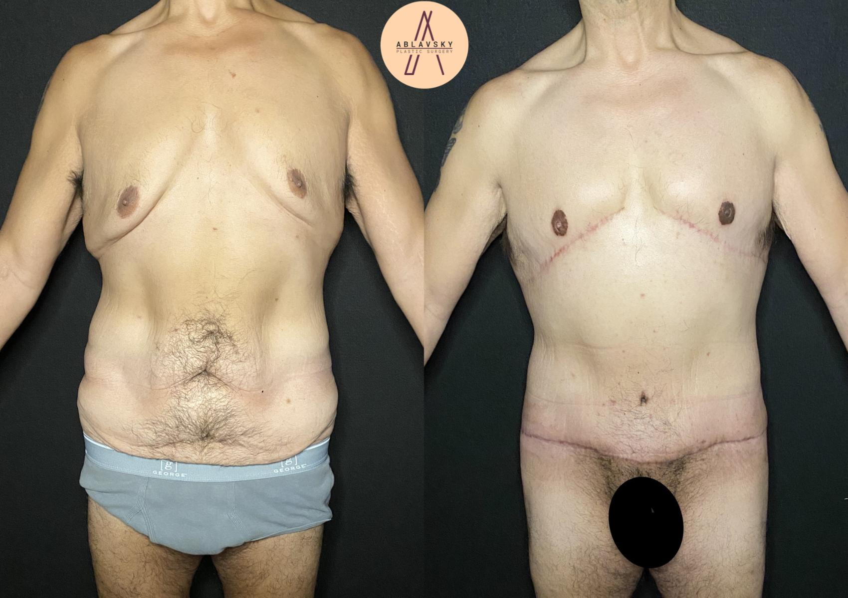 Before & After Gynecomastia Surgery Case 192 Front View in San Antonio, Texas
