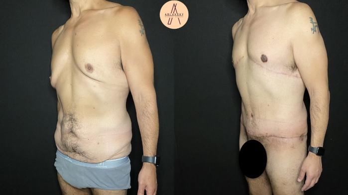Before & After Male Tummy Tuck Case 192 Left Oblique View in San Antonio, Texas