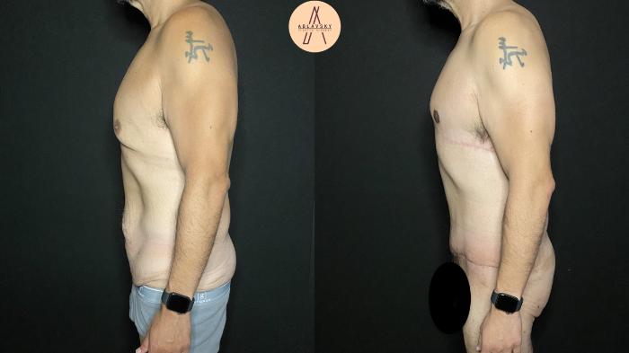Before & After Gynecomastia Surgery Case 192 Left Side View in San Antonio, Texas