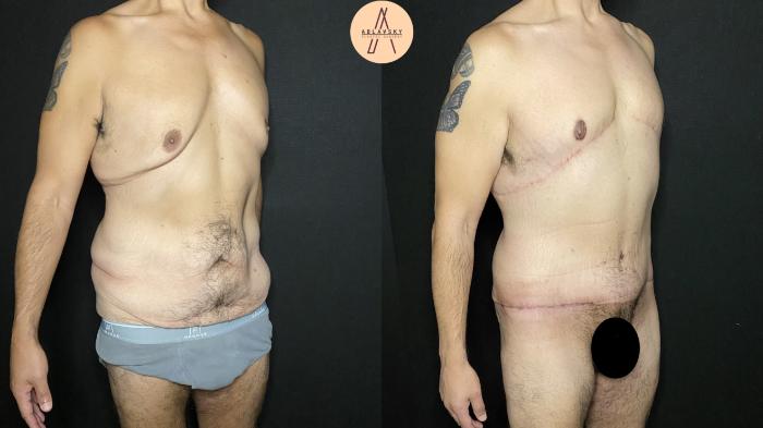 Before & After Male Tummy Tuck Case 192 Right Oblique View in San Antonio, Texas