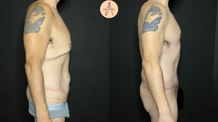 Before & After Gynecomastia Surgery Case 192 Right Side View in San Antonio, Texas