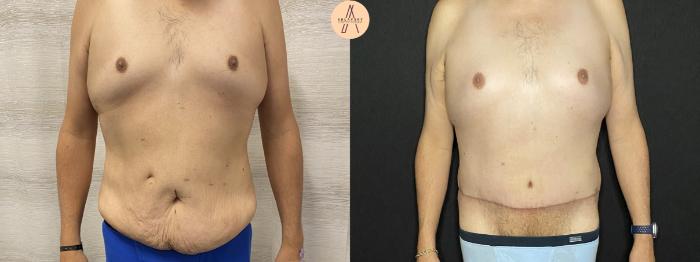 Before & After Male Tummy Tuck Case 204 Front View in San Antonio, Texas