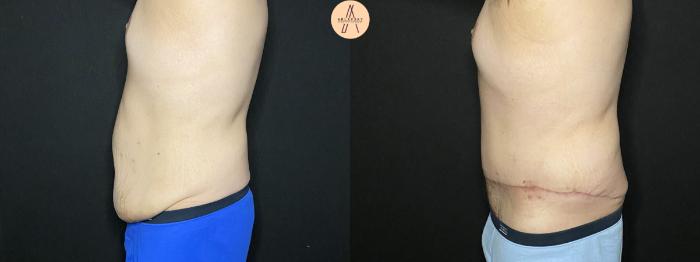 Before & After Male Tummy Tuck Case 204 Left Side View in San Antonio, Texas