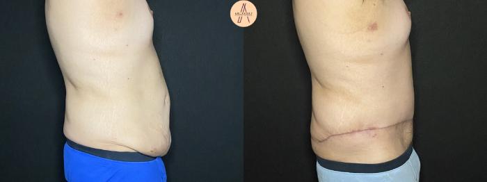 Before & After Male Tummy Tuck Case 204 Right Side View in San Antonio, Texas