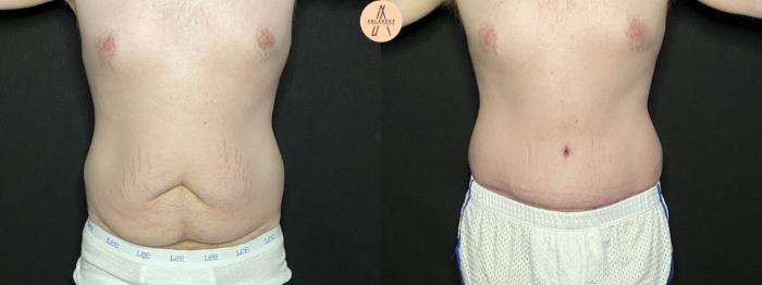 Before & After Male Tummy Tuck Case 205 Front View in San Antonio, Texas
