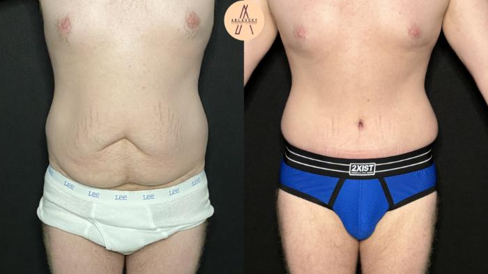 Before & After Male Tummy Tuck Case 266 Front View in San Antonio, Texas