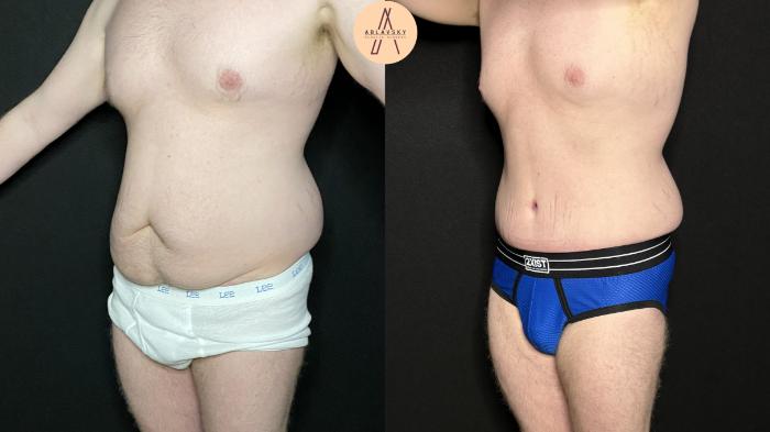 Before & After Male Tummy Tuck Case 266 Left Oblique View in San Antonio, Texas