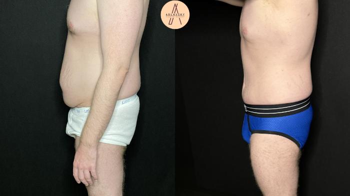 Before & After Male Tummy Tuck Case 266 Left Side View in San Antonio, Texas