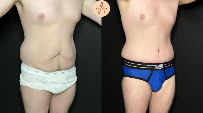 Before & After Male Tummy Tuck Case 266 Right Oblique View in San Antonio, Texas