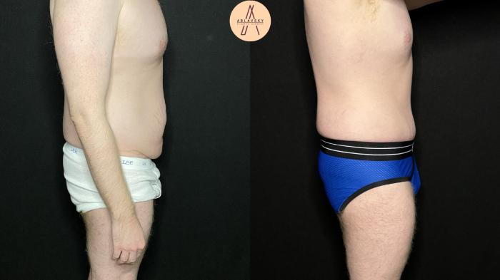 Before & After Male Tummy Tuck Case 266 Right Side View in San Antonio, Texas