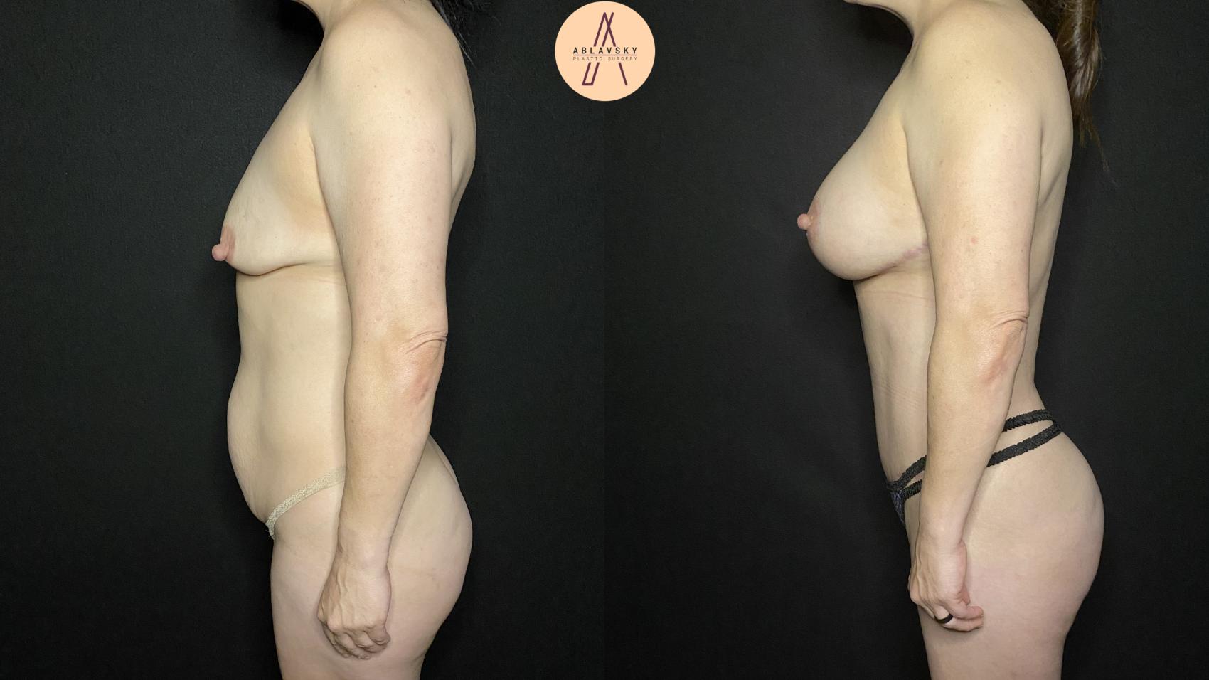 Before & After Mommy Makeover Case 154 Left Side View in San Antonio, Texas