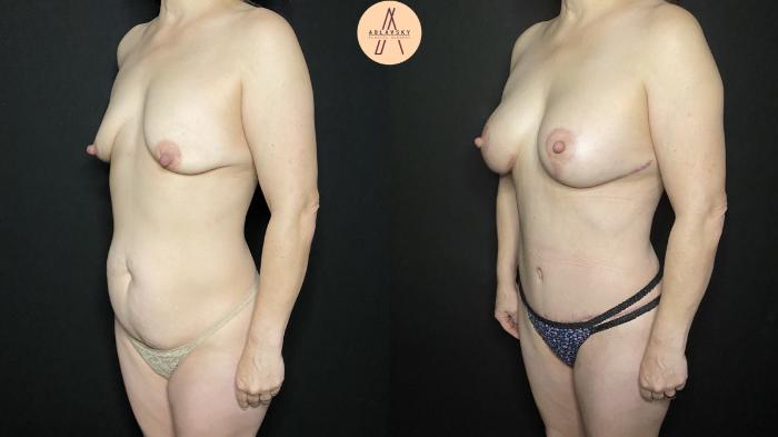 Before & After Mommy Makeover Case 154 Right Oblique View in San Antonio, Texas