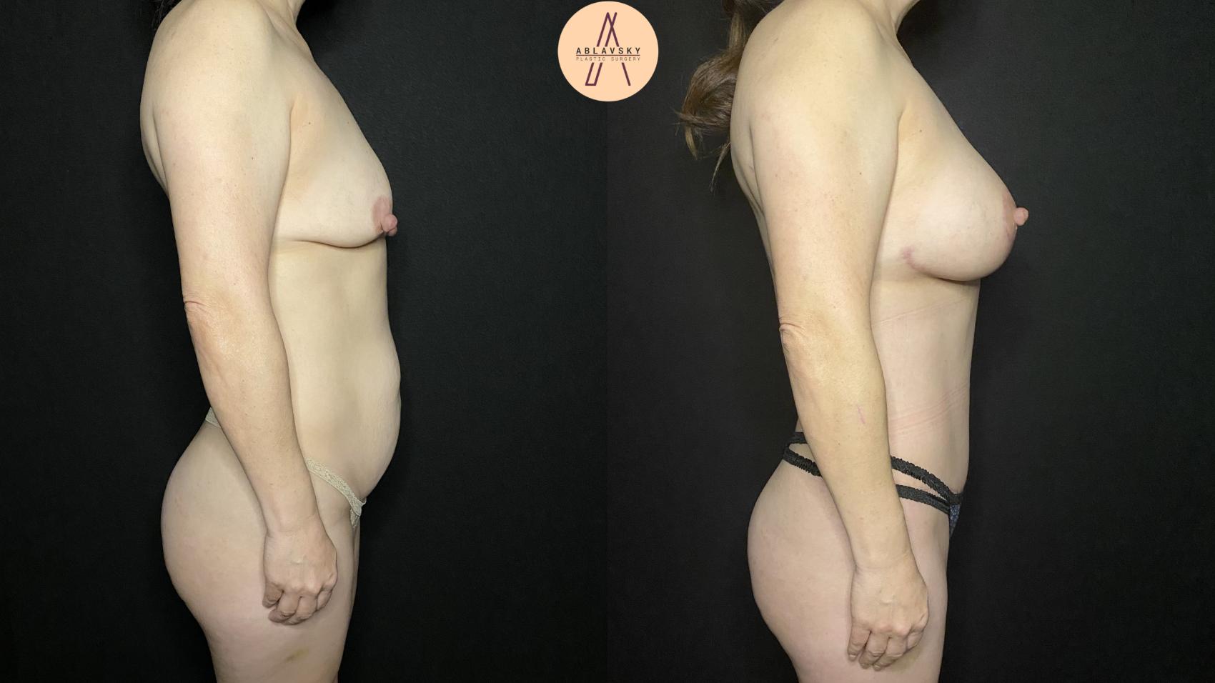 Before & After Mommy Makeover Case 154 Right Side View in San Antonio, Texas