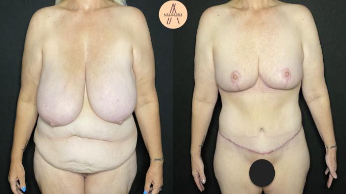 Before & After Breast Reduction Case 156 Front View in San Antonio, Texas