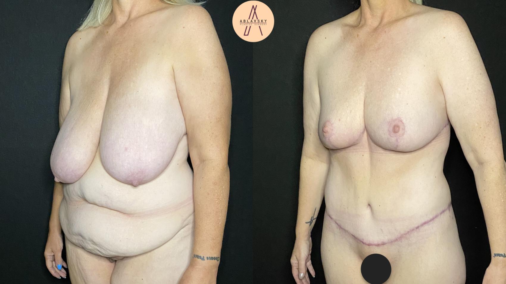 Before & After Tummy Tuck Case 156 Left Oblique View in San Antonio, Texas