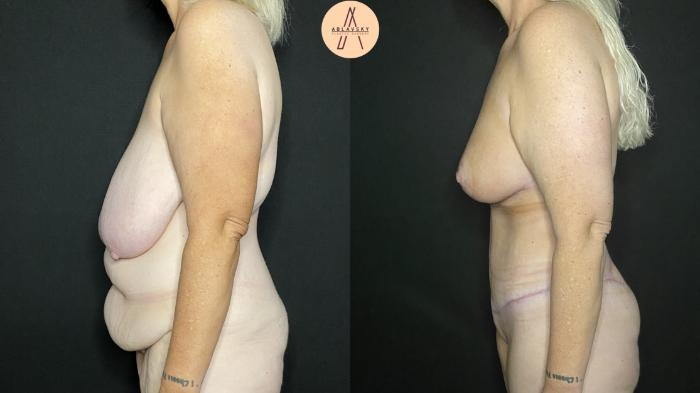 Before & After Tummy Tuck Case 156 Left Side View in San Antonio, Texas