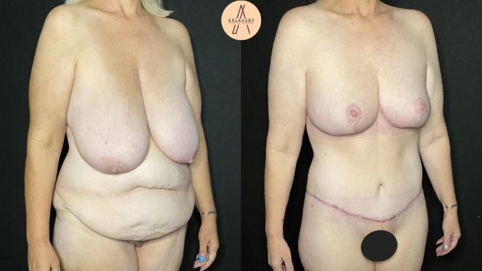 Before & After Liposuction Case 156 Right Oblique View in San Antonio, Texas