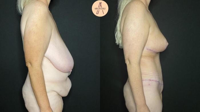 Before & After Tummy Tuck Case 156 Right Side View in San Antonio, Texas