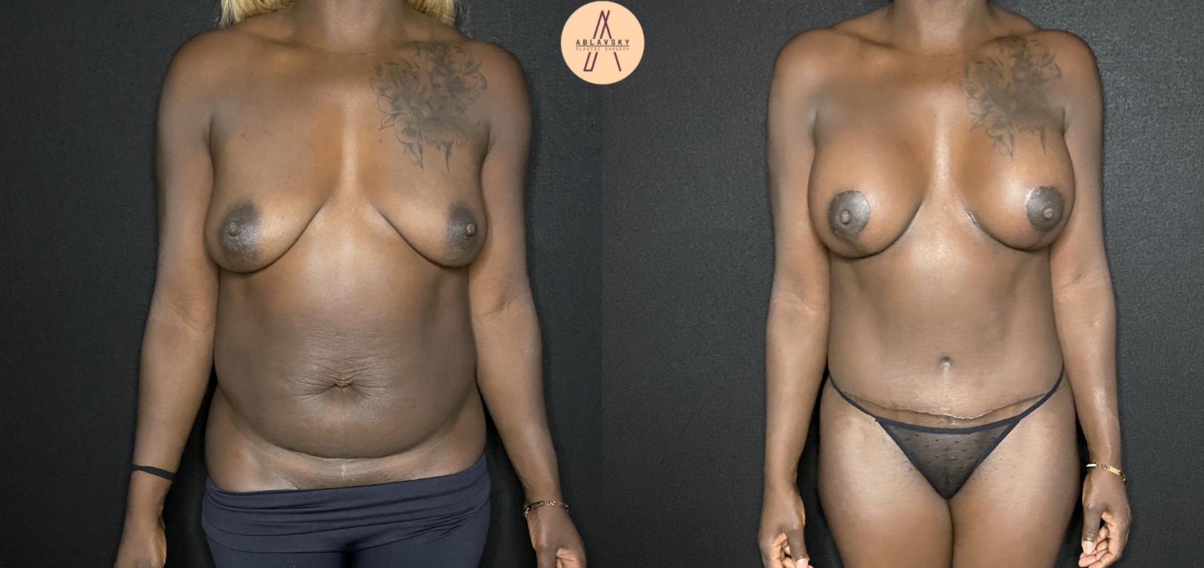 Before & After Breast Augmentation Case 158 Front View in San Antonio, Texas