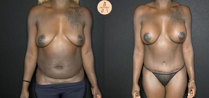 Before & After Breast Augmentation Case 158 Front View in San Antonio, Texas
