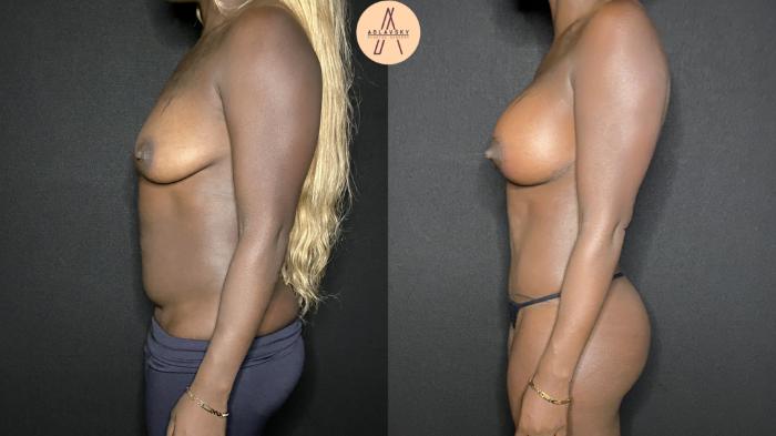 Before & After Breast Augmentation Case 158 Left Side View in San Antonio, Texas