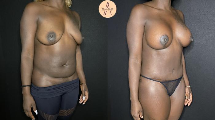Before & After Liposuction Case 158 Right Oblique View in San Antonio, Texas