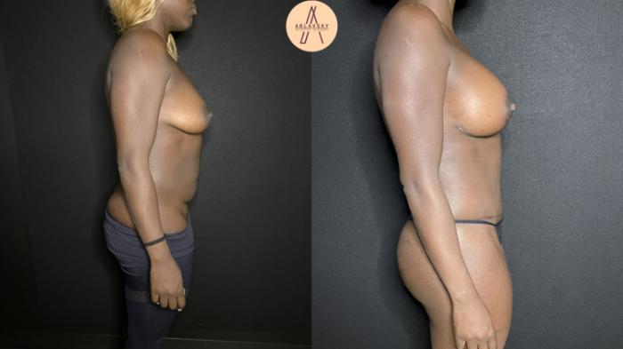 Before & After Liposuction Case 158 Right Side View in San Antonio, Texas