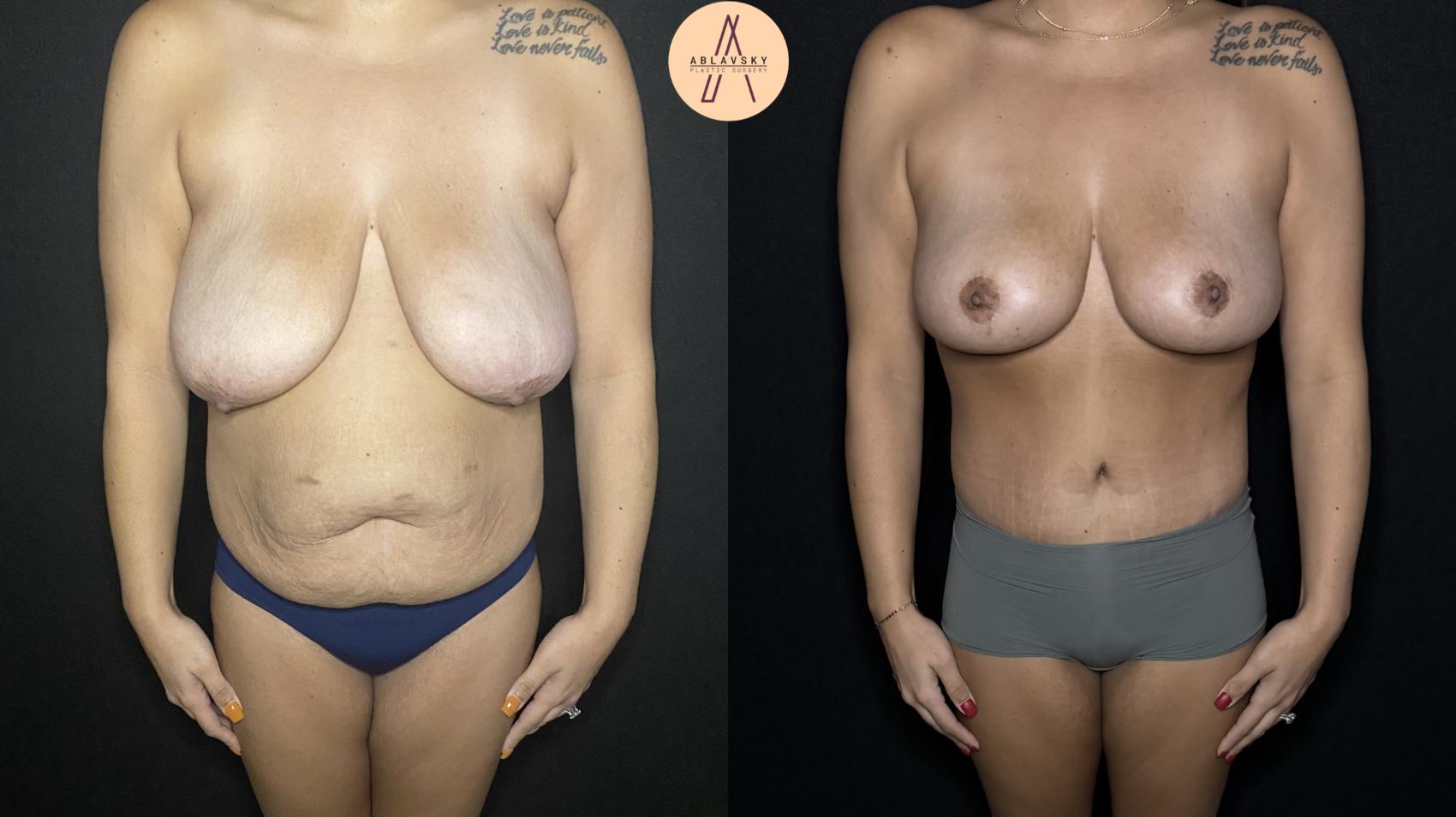 Before & After Mommy Makeover Case 165 Front View in San Antonio, Texas