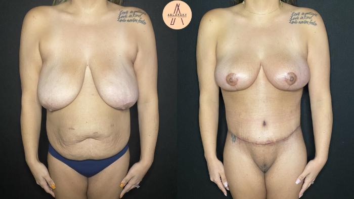 Before & After Breast Reduction Case 165 Front View in San Antonio, Texas