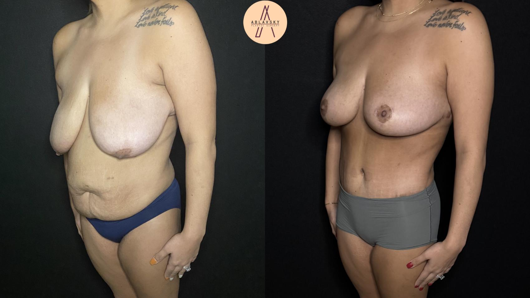 Before & After Mommy Makeover Case 165 Left Oblique View in San Antonio, Texas