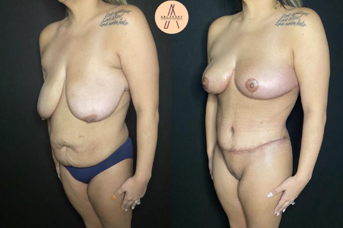 Before & After Tummy Tuck Case 165 Left Oblique View in San Antonio, Texas