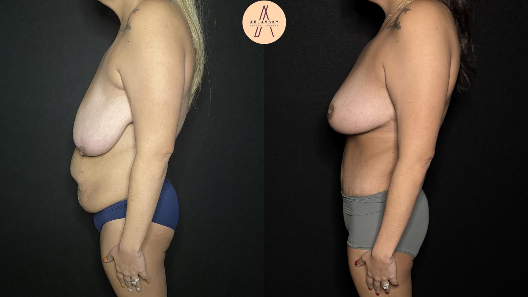 Before & After Mommy Makeover Case 165 Left Side View in San Antonio, Texas