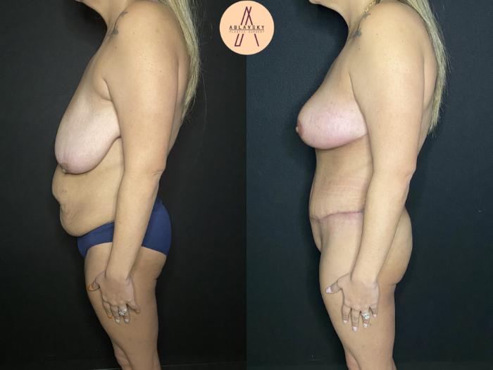Before & After Liposuction Case 165 Left Side View in San Antonio, Texas
