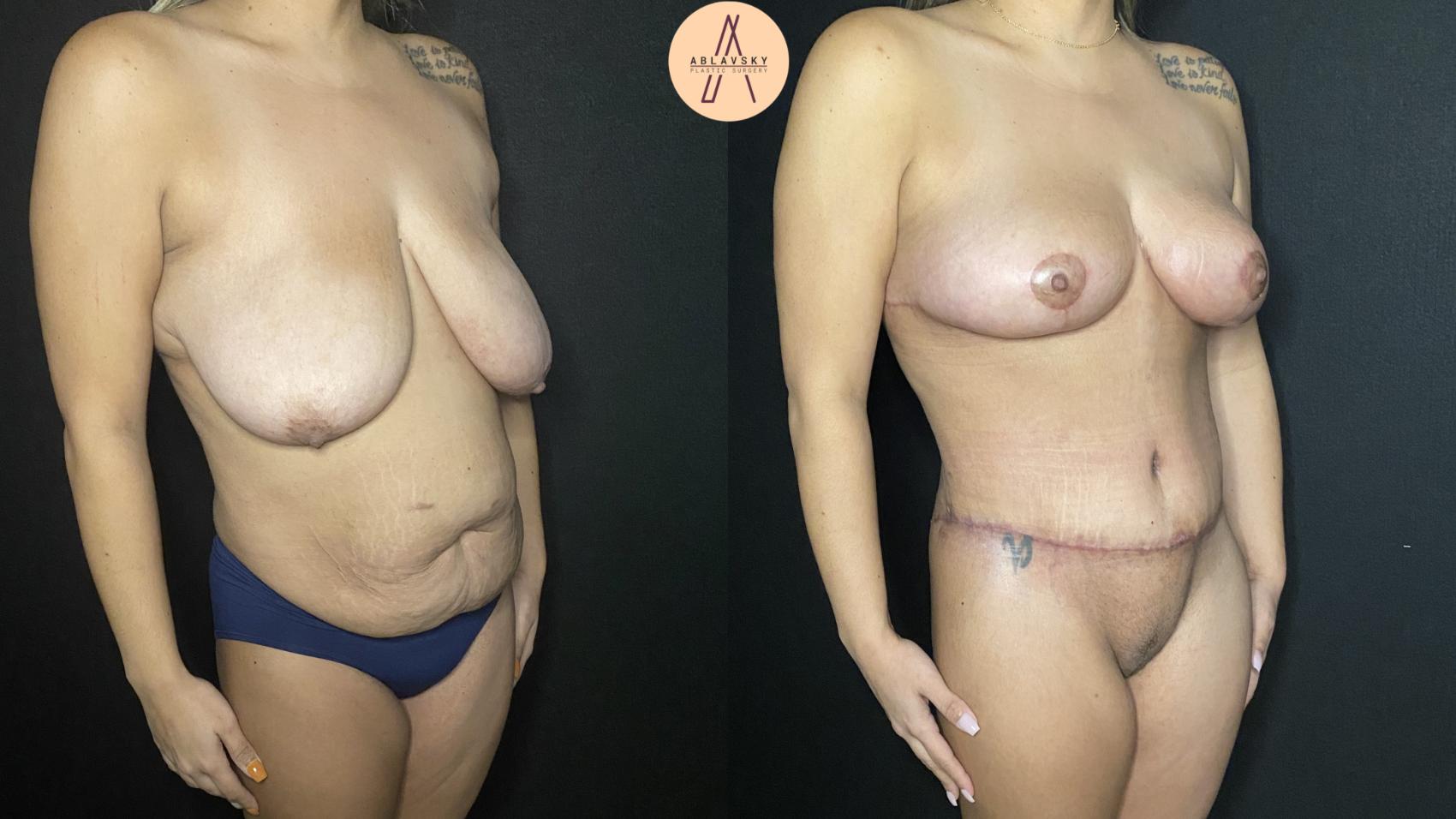 Before & After Mommy Makeover Case 165 Right Oblique View in San Antonio, Texas