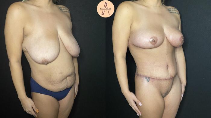 Before & After Tummy Tuck Case 165 Right Oblique View in San Antonio, Texas