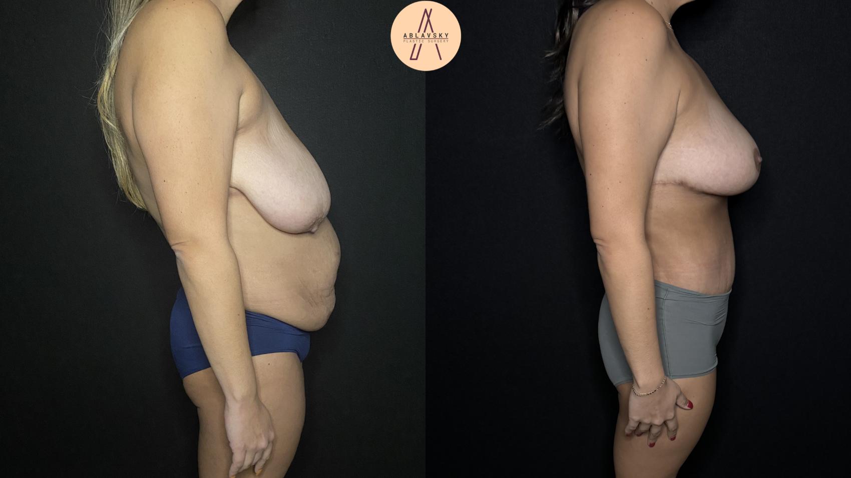 Before & After Mommy Makeover Case 165 Right Side View in San Antonio, Texas