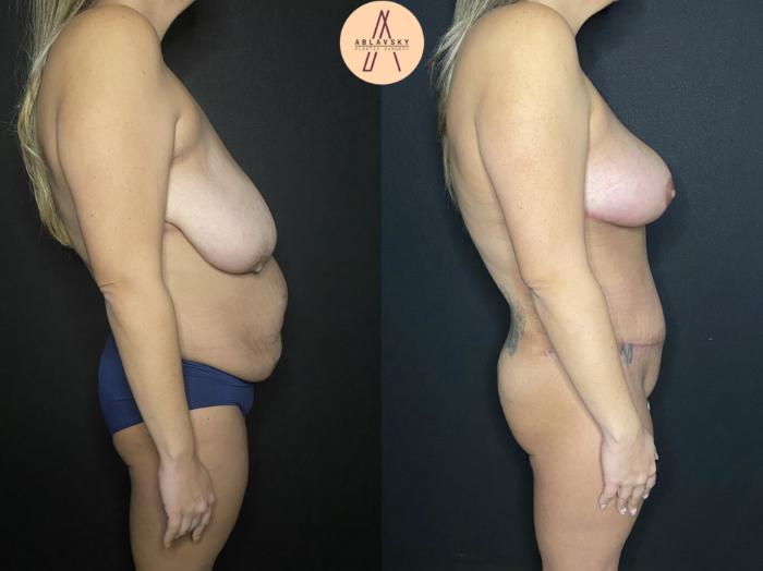 Before & After Liposuction Case 165 Right Side View in San Antonio, Texas