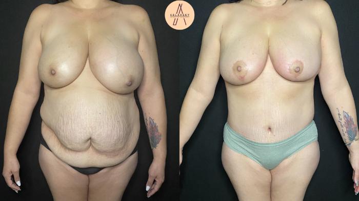 Before & After Tummy Tuck Case 170 Front View in San Antonio, Texas