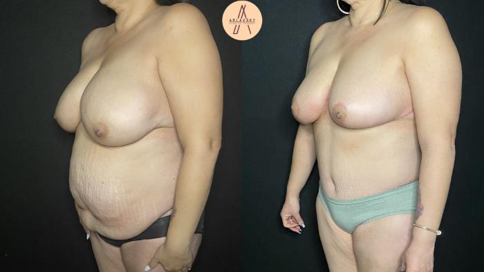 Before & After Tummy Tuck Case 170 Left Oblique View in San Antonio, Texas