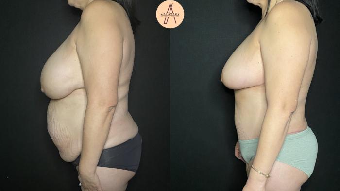 Before & After Tummy Tuck Case 170 Left Side View in San Antonio, Texas
