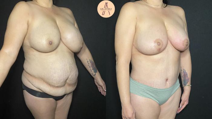Before & After Tummy Tuck Case 170 Right Oblique View in San Antonio, Texas