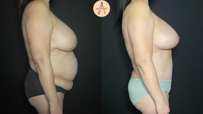 Before & After Liposuction Case 170 Right Side View in San Antonio, Texas