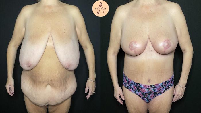 Before & After Breast Reduction Case 182 Front View in San Antonio, Texas