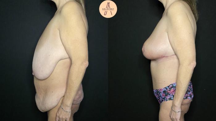Before & After Tummy Tuck Case 182 Left Side View in San Antonio, Texas