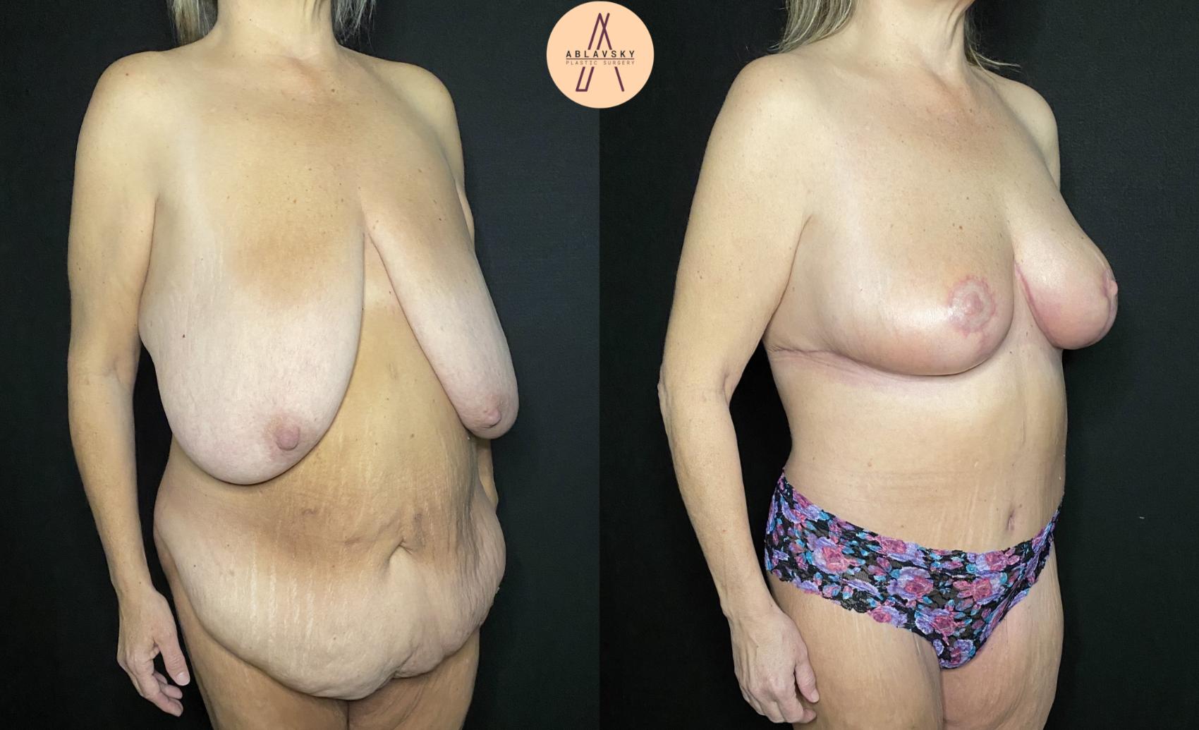 Before & After Breast Lift Case 182 Right Oblique View in San Antonio, Texas